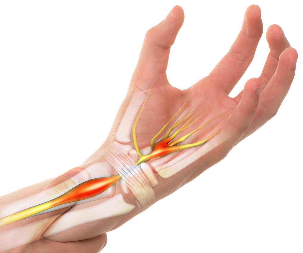 Carpal Tunnel Syndrome